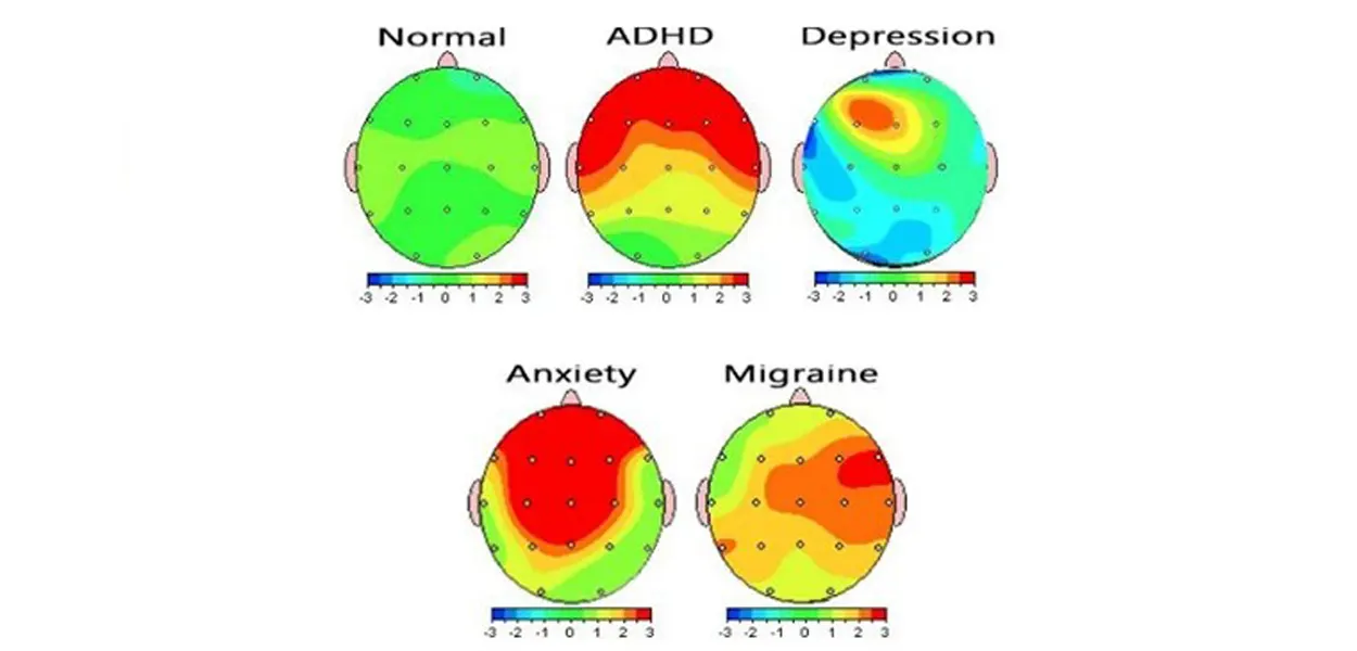 نقشه مغزی qeeg اسکن مغزی نوار مغز