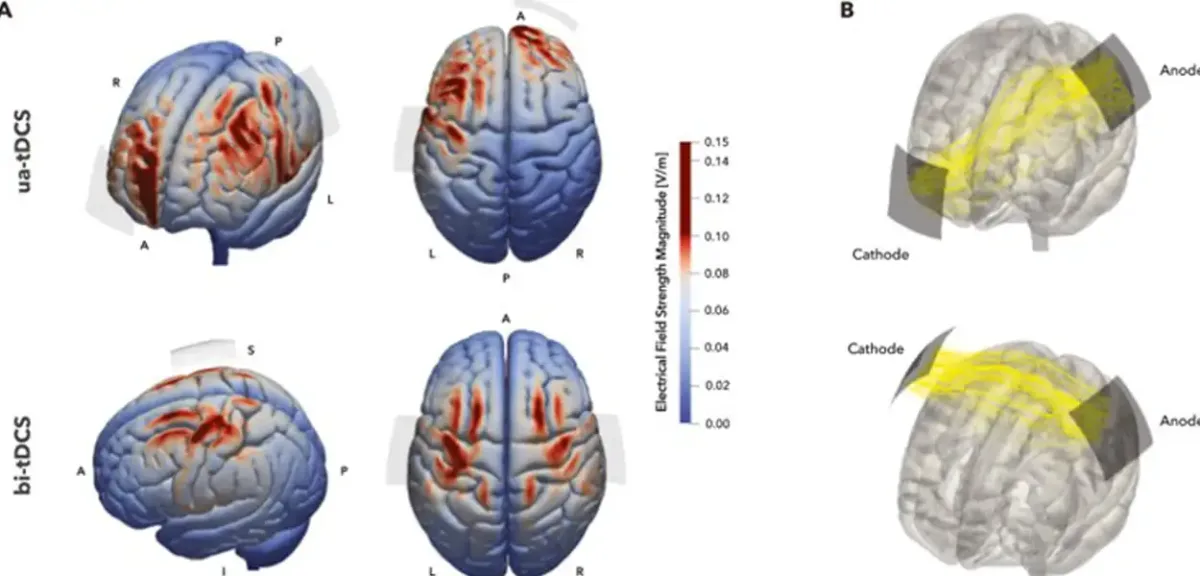 تحریک الکتریکی مغزی یا tDCS